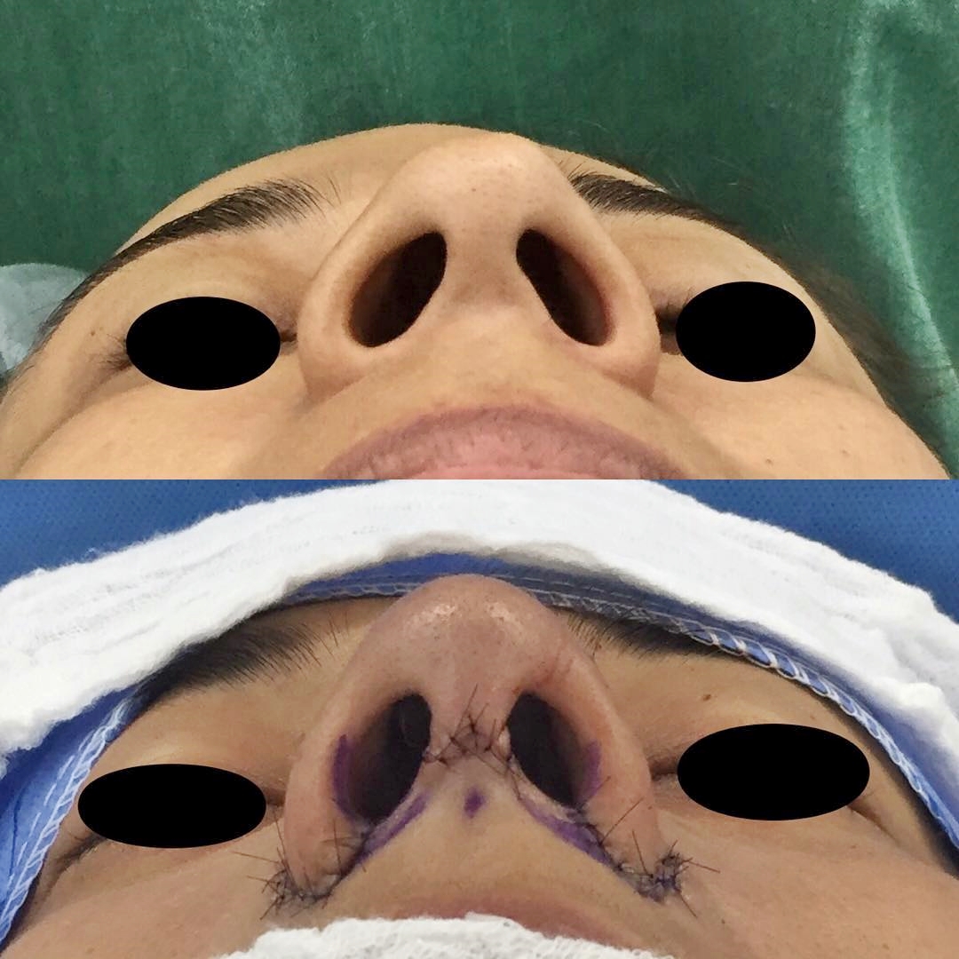 Rinoplastia com redução de base alar