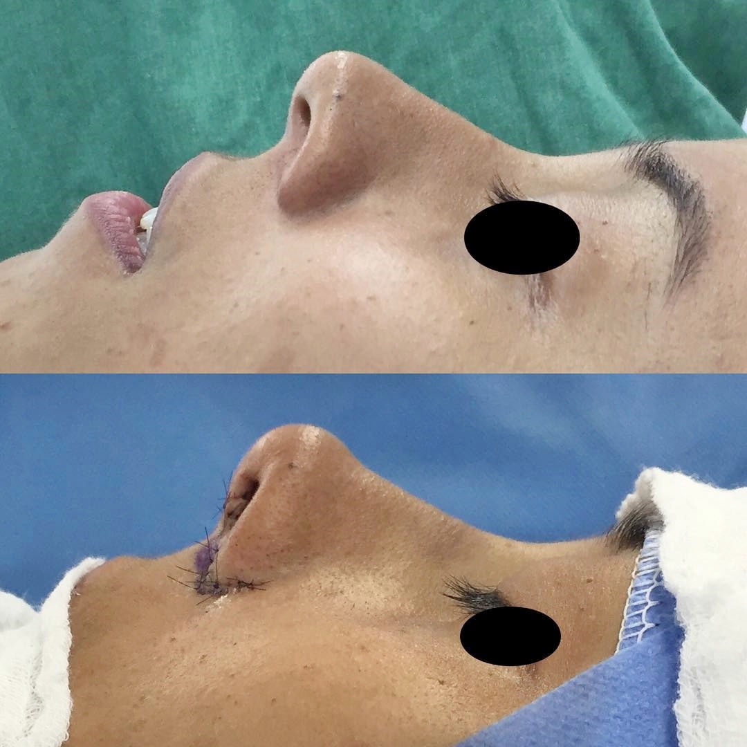 Rinoplastia com redução de base alar
