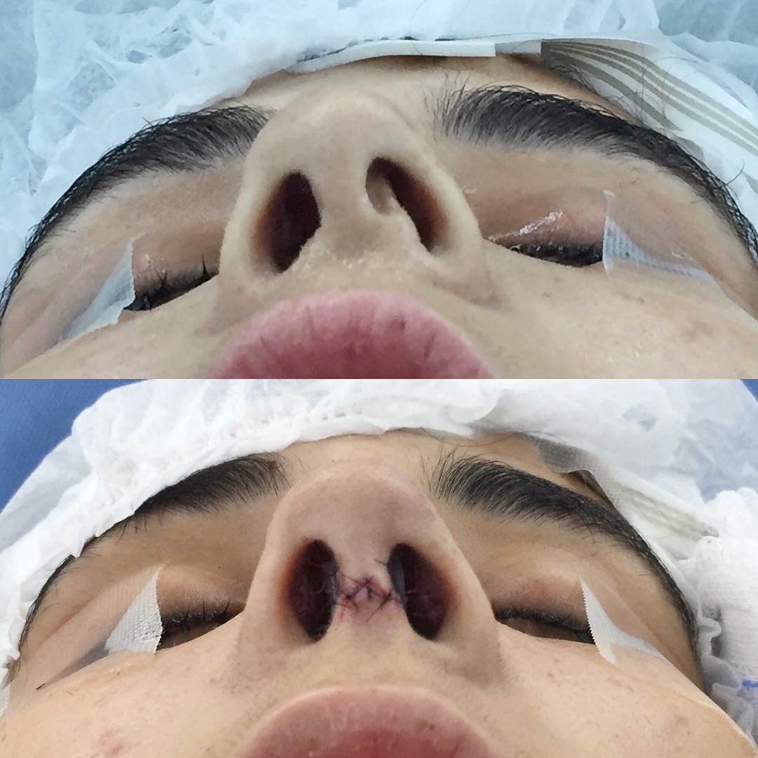 Paciente pós cirurgia de Rinoplastia com desvio de septo