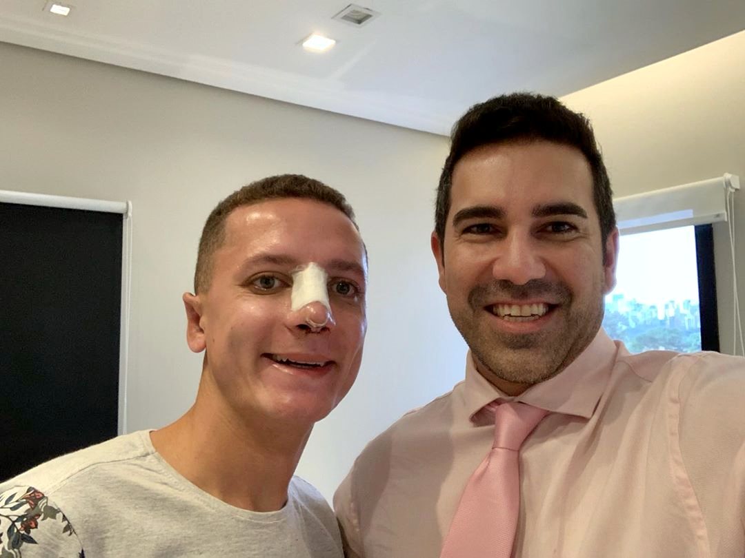 Apenas 5 dias após cirurgia de rinoplastia + otoplastia