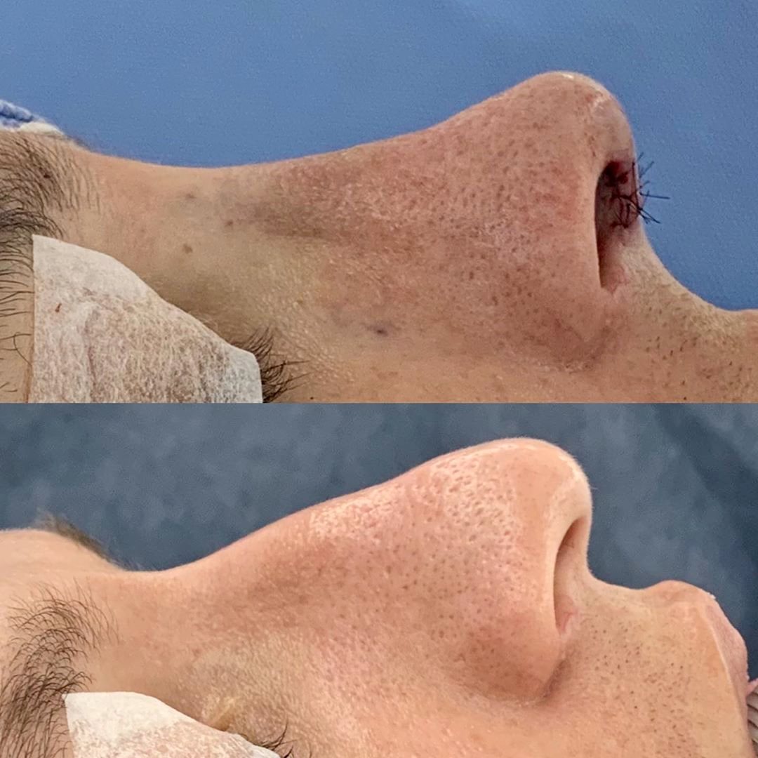 Harmonia e simetria, condições fundamentais para uma rinoplastia de sucesso