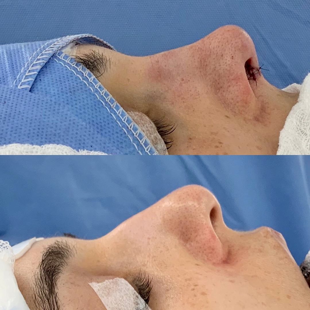 Dia de rinoplastia
