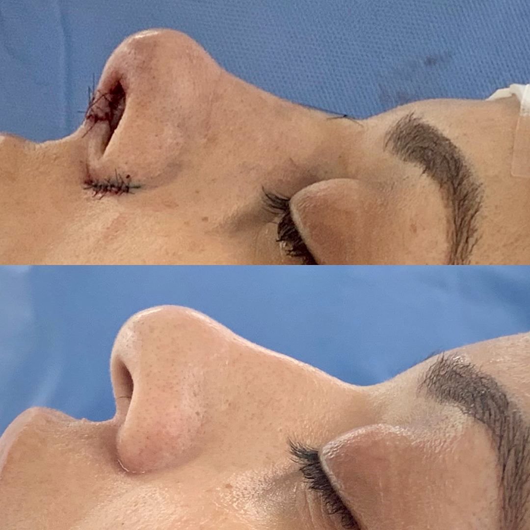 Rinoplastia em nariz étnicos requer um volume maior de cartilagem para enxerto
