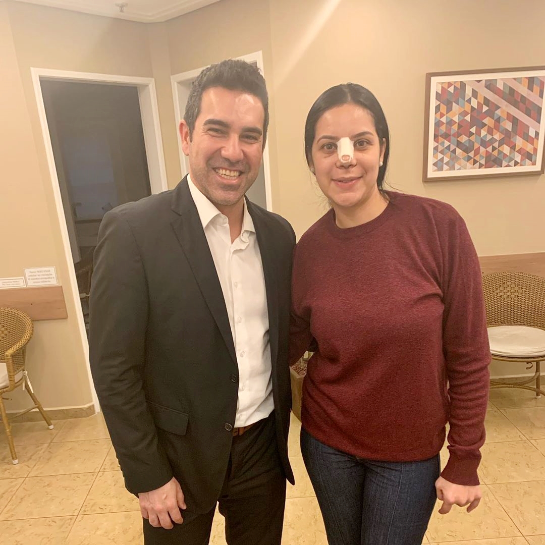 5 dias após rinoplastia com uma recuperação excelente!