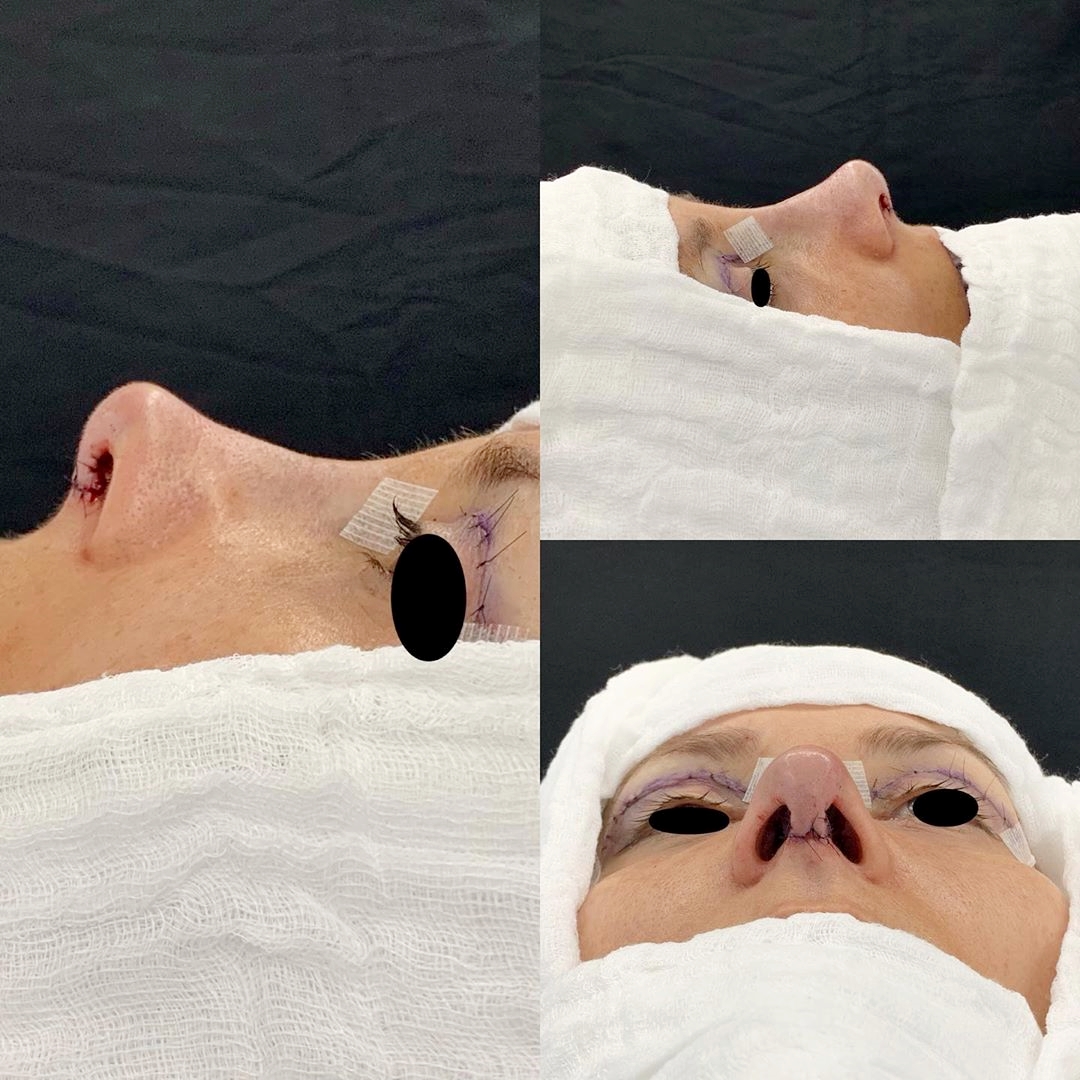 Rinoplastia + Blefaroplastia! Procedimento conjugado para otimizar o tempo do paciente!