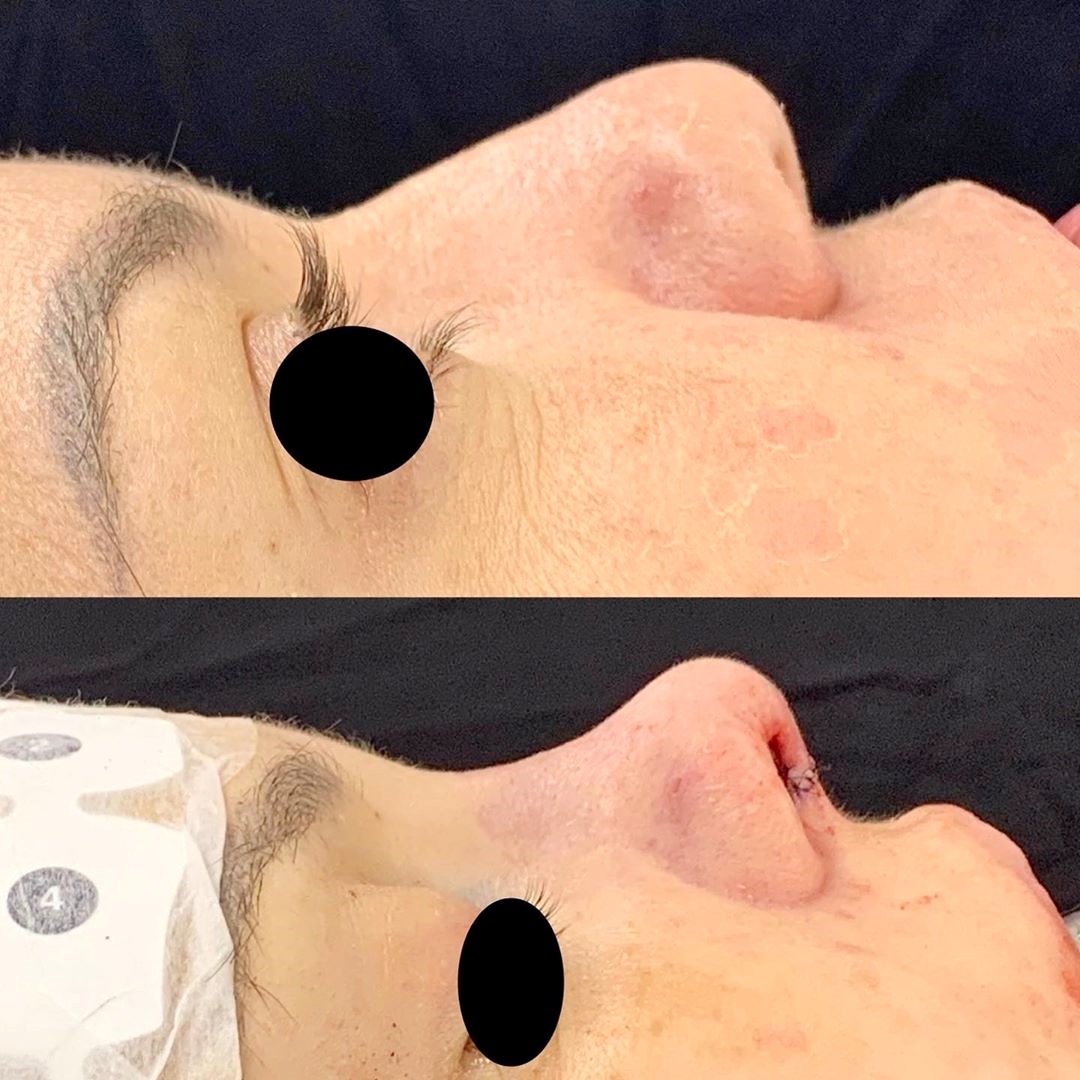 Rinoplastia secundária após estigmas da primeira cirurgia