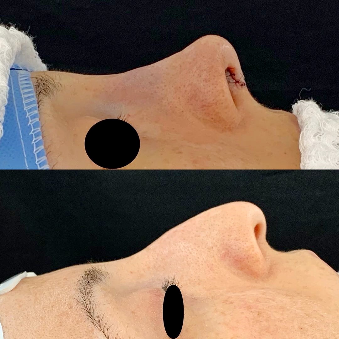 Após 4 horas de cirurgia