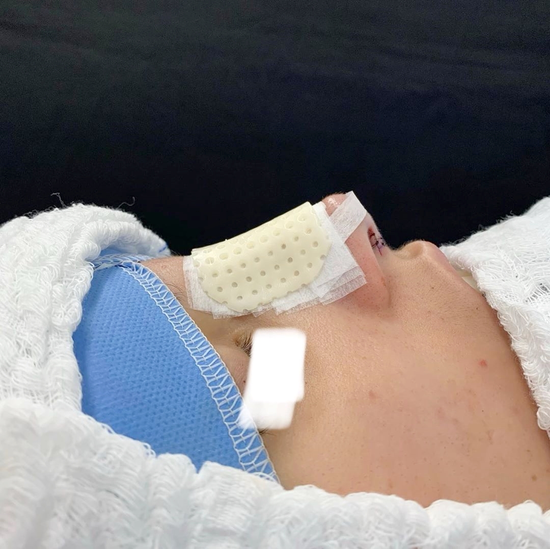 Após a rinoplastia é realizado o curativo nasal