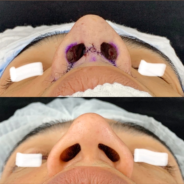 O estreitamento de base nasal serve para diminuir a largura do nariz